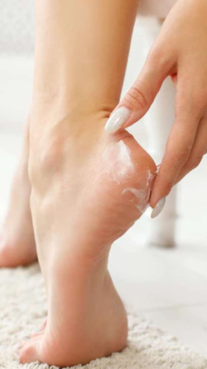 Are you troubled by cracked heels, try these remedies
